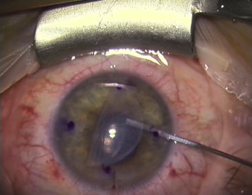 Suture pull-through insertion of graft donor in Descemet stripping automated endothelial keratoplasty: Results of 4-year follow-up